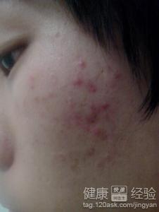 ��ʲôҩ�����Ʊ�ƽ����