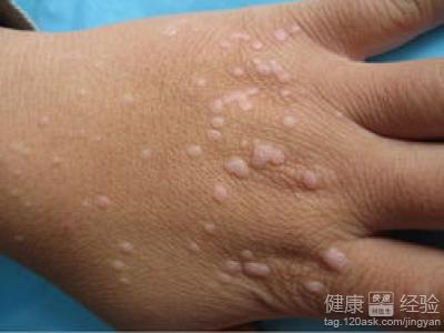 脸上长扁平疣有没有什么注意事宜呢