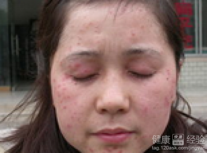 眼部扁平疣尽快治疗以免影响美观