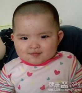 ÷���ͱ�ƽ��֢״��ʲô����