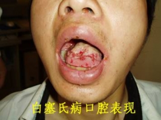 查病网口腔溃疡连发竟然是白塞氏病 查病网口腔溃疡连发竟然是白塞氏病