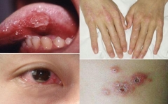 免疫异常会引发白塞氏病吗?有哪些症状 免疫异常会引发白塞氏病吗?有哪些症状