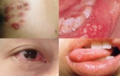 查病网专家介绍白塞病诱发的原因是什么 查病网专家介绍白塞病诱发的原因是什么