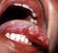 白塞病会使患者出现复发性口腔溃疡吗 白塞病会使患者出现复发性口腔溃疡吗