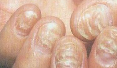 灰指甲有感觉吗 灰指甲有感觉吗