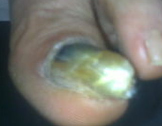 小孩有灰指甲是缺什么 小孩有灰指甲是缺什么