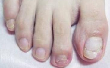 灰指甲用醋泡脚好吗 灰指甲用醋泡脚好吗