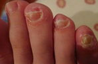 灰指甲怎样不传染 灰指甲怎样不传染