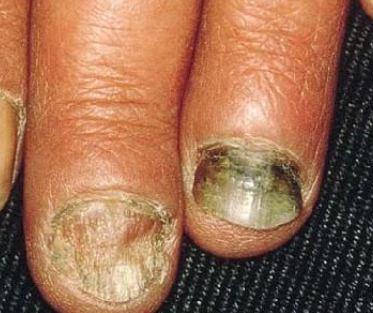 ��ָ�׵�Σ����ʲô