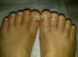 ��ֹ��ָ�״�Ⱦ