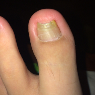 灰指甲传染宝宝怎么办 灰指甲传染宝宝怎么办