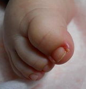 ��ͯ��ָ�׻ᴫȾ��