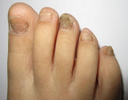 灰指甲很臭吗 灰指甲很臭吗