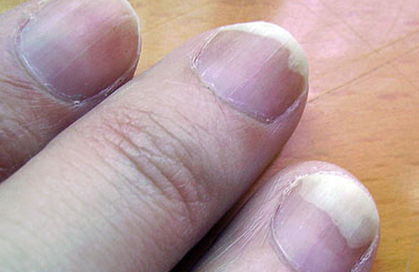 灰指甲有什么害处 灰指甲有什么害处