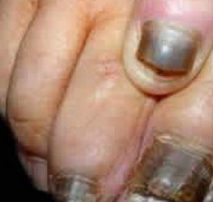 灰指甲是缺什么 灰指甲是缺什么