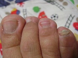 灰指甲传染条件 灰指甲传染条件