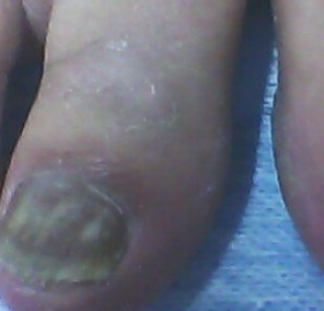 灰指甲的危害是什么 灰指甲的危害是什么