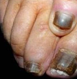 灰指甲可以传染吗 灰指甲可以传染吗