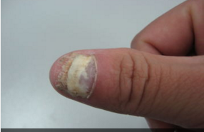 灰指甲的后果 灰指甲的后果