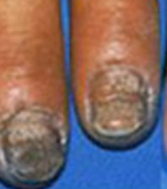 治疗灰指甲用什么药好 治疗灰指甲用什么药好