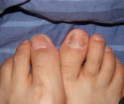 孕妇能治疗灰指甲吗 孕妇能治疗灰指甲吗