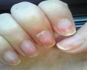 早期灰指甲如何治疗 早期灰指甲如何治疗