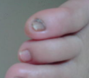 大蒜加醋治疗灰指甲 大蒜加醋治疗灰指甲