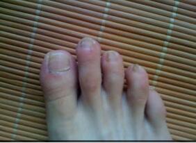 灰指甲的初期治疗 灰指甲的初期治疗