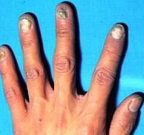 白醋怎么治疗灰指甲 白醋怎么治疗灰指甲