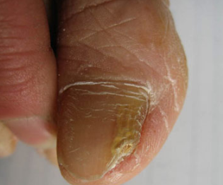 民间治疗灰指甲方法 民间治疗灰指甲方法