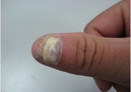 灰指甲的治疗常用药 灰指甲的治疗常用药