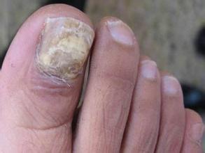 中医治疗灰指甲的偏方 中医治疗灰指甲的偏方