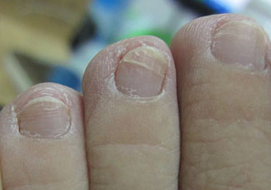 如何治疗灰指甲不复发 如何治疗灰指甲不复发