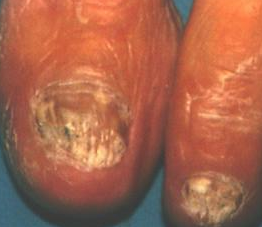 灰指甲用什么药好的快 灰指甲用什么药好的快