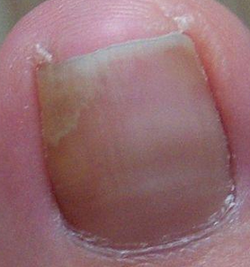 白醋泡脚治疗灰指甲 白醋泡脚治疗灰指甲