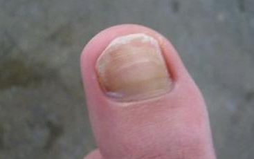 灰指甲特效药 灰指甲特效药