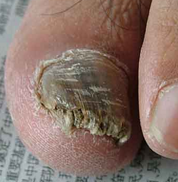 灰指甲要不要治疗 灰指甲要不要治疗