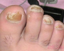 灰指甲初期治疗偏方 灰指甲初期治疗偏方