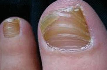 儿童<a href=/hzjzl/ target=_blank class=infotextkey>灰指甲治疗方法</a> 儿童灰指甲治疗方法