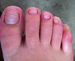 脚上灰指甲用什么药 脚上灰指甲用什么药