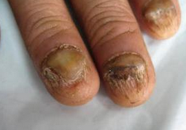 灰指甲的中医治疗 灰指甲的中医治疗