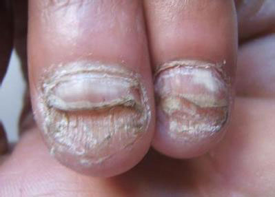 怎样治疗灰指甲最快 怎样治疗灰指甲最快