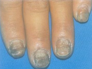 治灰指甲用什么药好 治灰指甲用什么药好