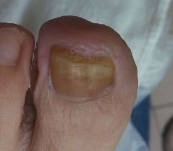 得灰指甲吃什么药 得灰指甲吃什么药