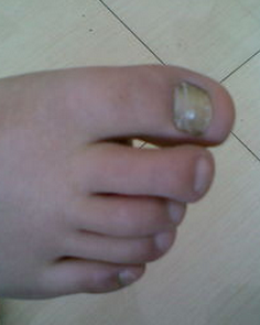 怎样治疗灰指甲不复发 怎样治疗灰指甲不复发