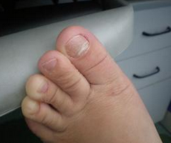 醋泡大蒜治疗灰指甲 醋泡大蒜治疗灰指甲