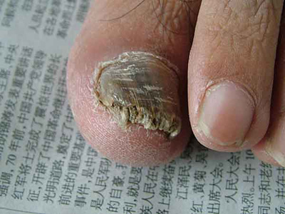 严重灰指甲的症状 严重灰指甲的症状