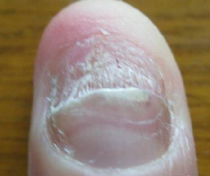 灰指甲早期的症状有哪些 灰指甲早期的症状有哪些