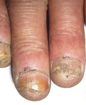 灰指甲开始的症状 灰指甲开始的症状