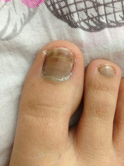 ��ָ�ײ���֢״